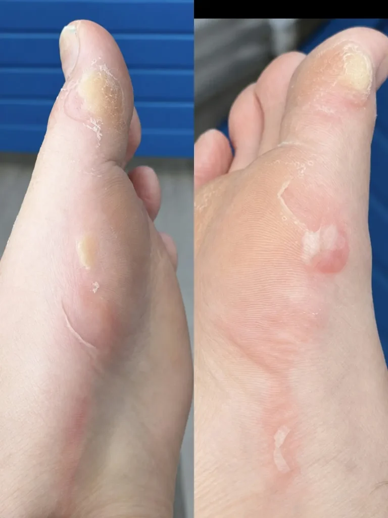 Plantas de los pies de Pablo tras la carrera, con ampollas y piel levantada junto al dedo gordo.